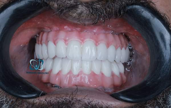 زراعة الزيجوما في الوجنة - مركز وندرز لعلاج الاسنان