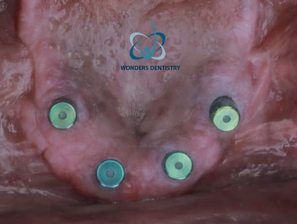 زراعة الزيجوما في الوجنة - مركز وندرز لعلاج الاسنان