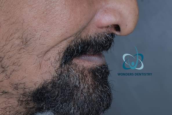 زراعة الزيجوما في الوجنة - مركز وندرز لعلاج الاسنان