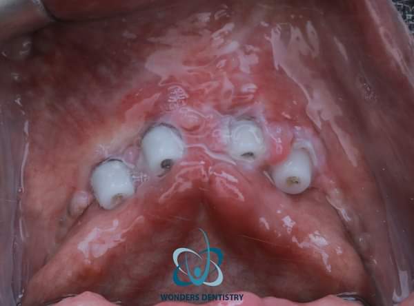 زراعة الزيجوما في الوجنة - مركز وندرز لعلاج الاسنان