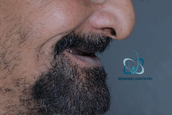 زراعة الزيجوما في الوجنة - مركز وندرز لعلاج الاسنان