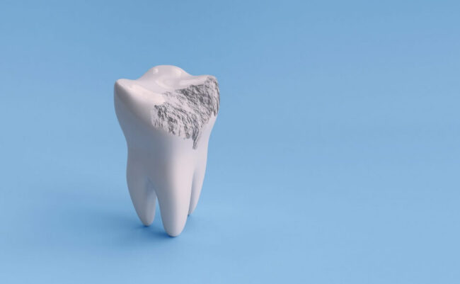 enamel tooth تآكل مينا الأسنان