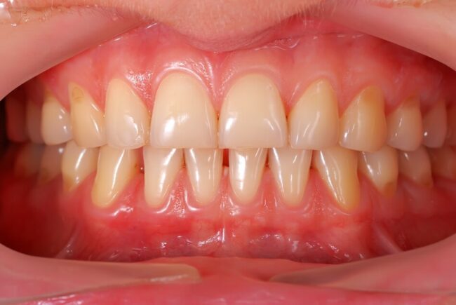 اللثة الحساسة - sensitive gums