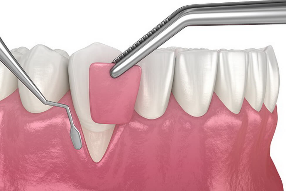 gum-graft ترقيع اللثة