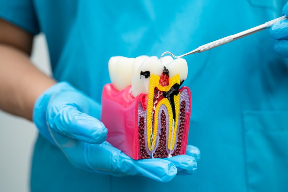 Tooth decay types علاج تسوس الاسنان - Tooth decay treatment