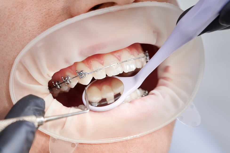 dentist-attaching-metal-braces-patient-teeth (1) كسر تقويم الأسنان