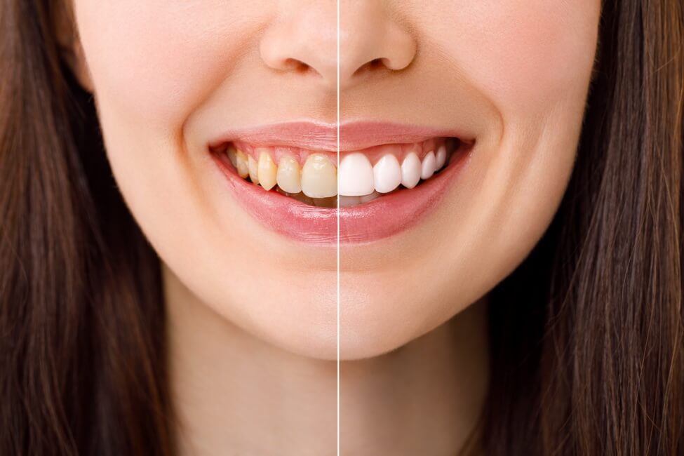 smiling-woman-before-after-teeth-whitening-procedure-closeup مدة تأثير تبييض الأسنان