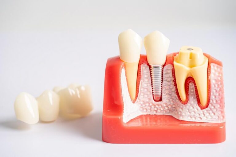 زراعة الأسنان الزيركون
