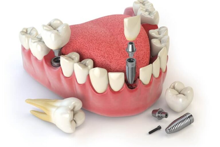 زراعة الأسنان الأمامية و زراعة الأسنان الخلفية