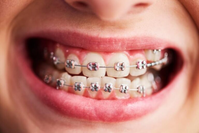 Orthodontic-not-just-a-look اجراء تقويم الأسنان