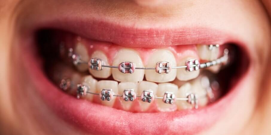 اجراء تقويم الأسنان