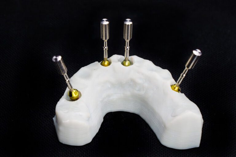 Zygomatic-implants-utilize-cheekbones فشل زراعة الزيجوما