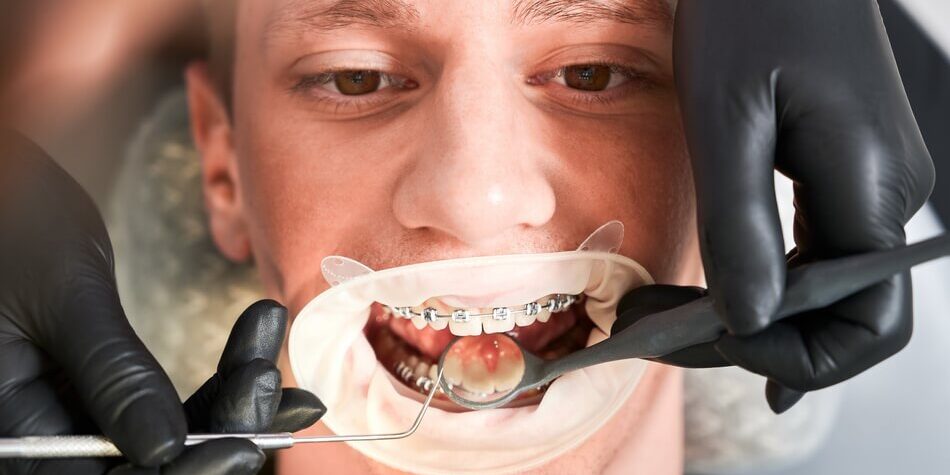 تقويم الأسنان الوقائي و التقويم العلاجي