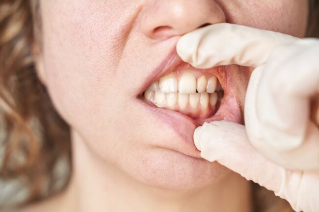 التهاب اللثة و الأسنان - prevent gum and tooth inflammation