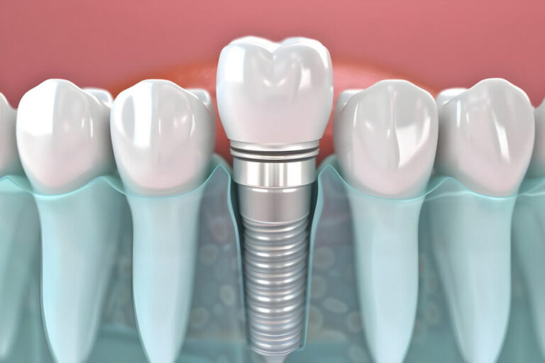 visual-representation-dental-implant-jaw-against-blue-background-concept-dental-implant-jaw-anatomy-medical-illustration-dental-health-blue-background (1) عمر زراعة الأسنان - Dental Implant Longevity