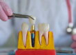 مضاعفات زراعة الاسنان - dental implant complications