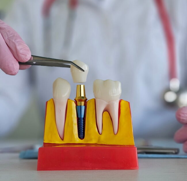 artificial-tooth-roots-dental-implant-into-jaw (1) مضاعفات زراعة الاسنان