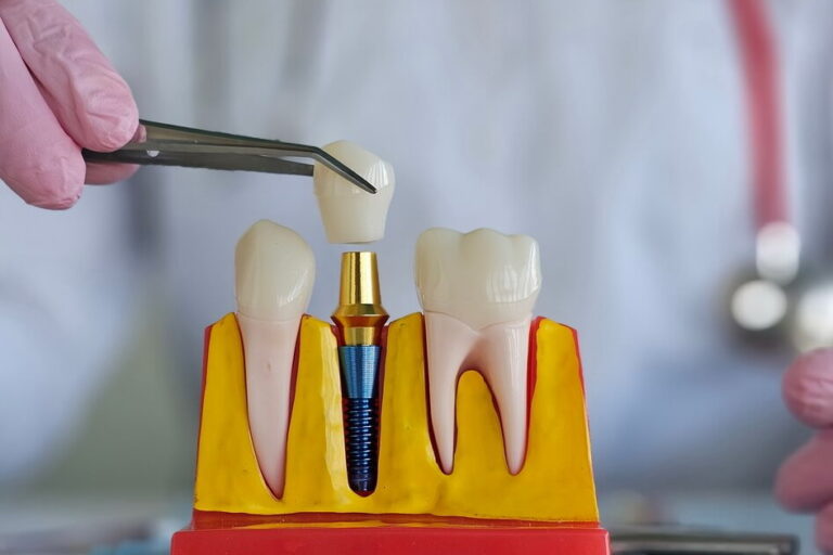 artificial-tooth-roots-dental-implant-into-jaw (1) مضاعفات زراعة الاسنان