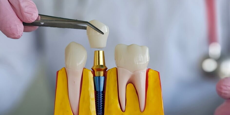 مضاعفات زراعة الاسنان - dental implant complications
