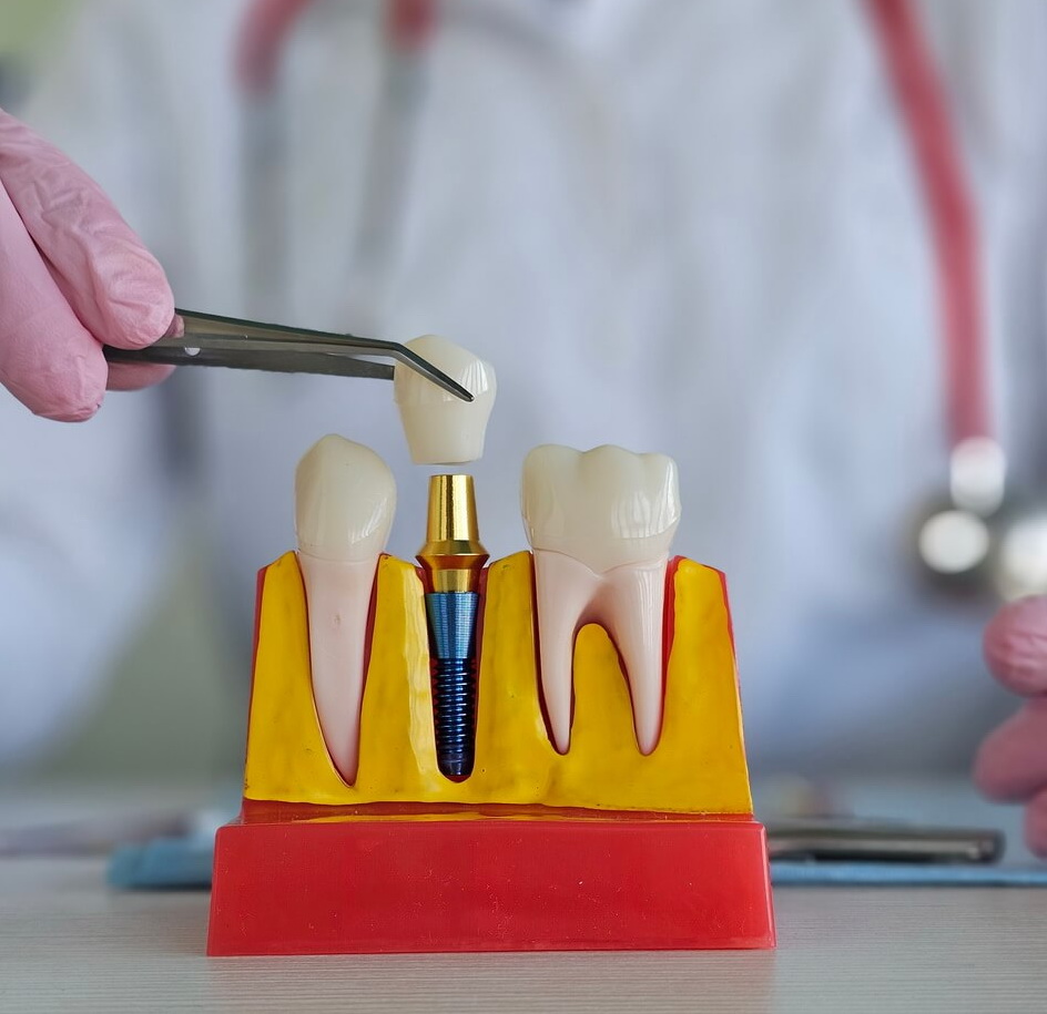 مضاعفات زراعة الاسنان - dental implant complications