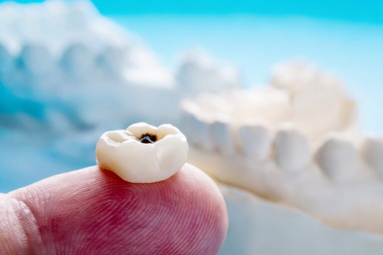 magnific__i-want-to-be-small-tooth-decay-under-the-crown (1) تسوس الأسنان تحت التركيبة - Tooth decay under crown