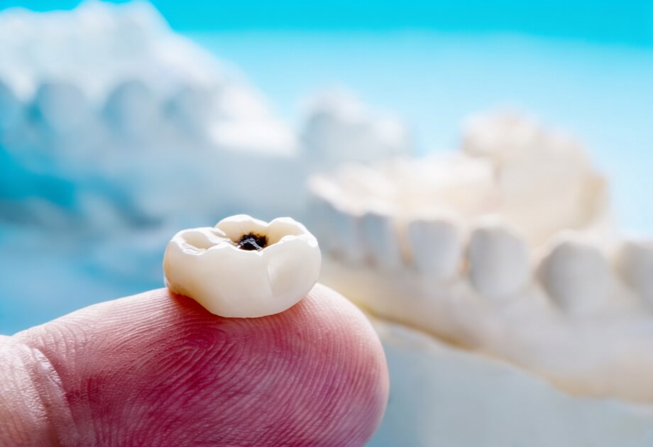 magnific__i-want-to-be-small-tooth-decay-under-the-crown (1) تسوس الأسنان تحت التركيبة - Tooth decay under crown