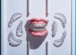التقويم الشفاف و التقويم المعدني - clear aligners and metal braces