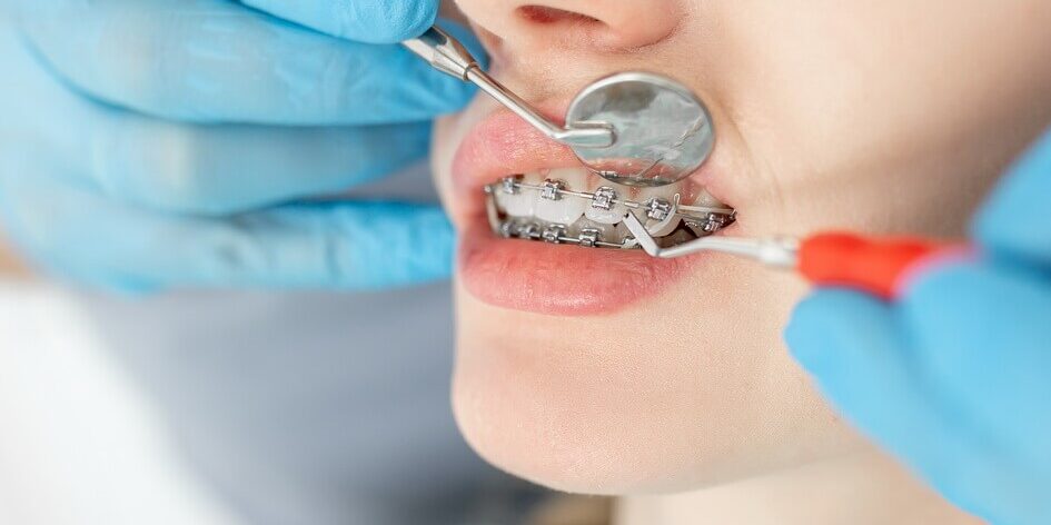 مدة علاج تقويم الأسنان - orthodontic treatment Duration