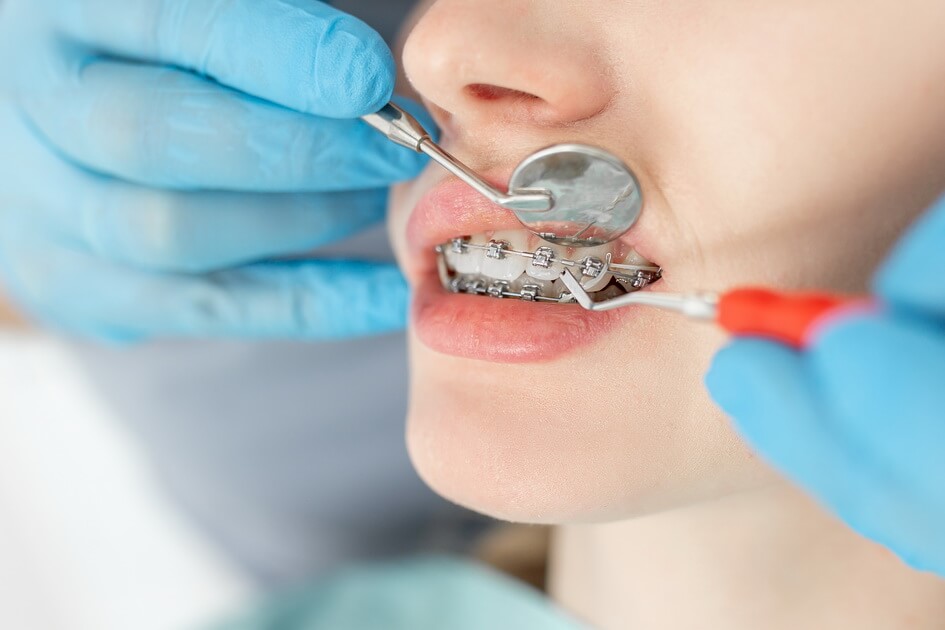closeup-young-woman-with-braces-dental-checkup (1) مدة علاج تقويم الأسنان